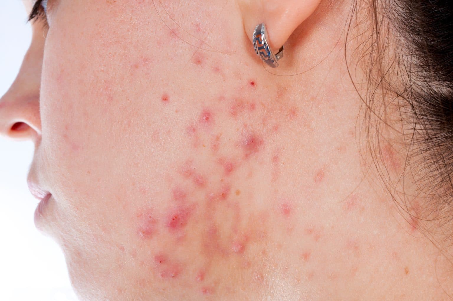 L'acné chez l'adulte Analyse approfondie des causes, traitements et conseils de prévention